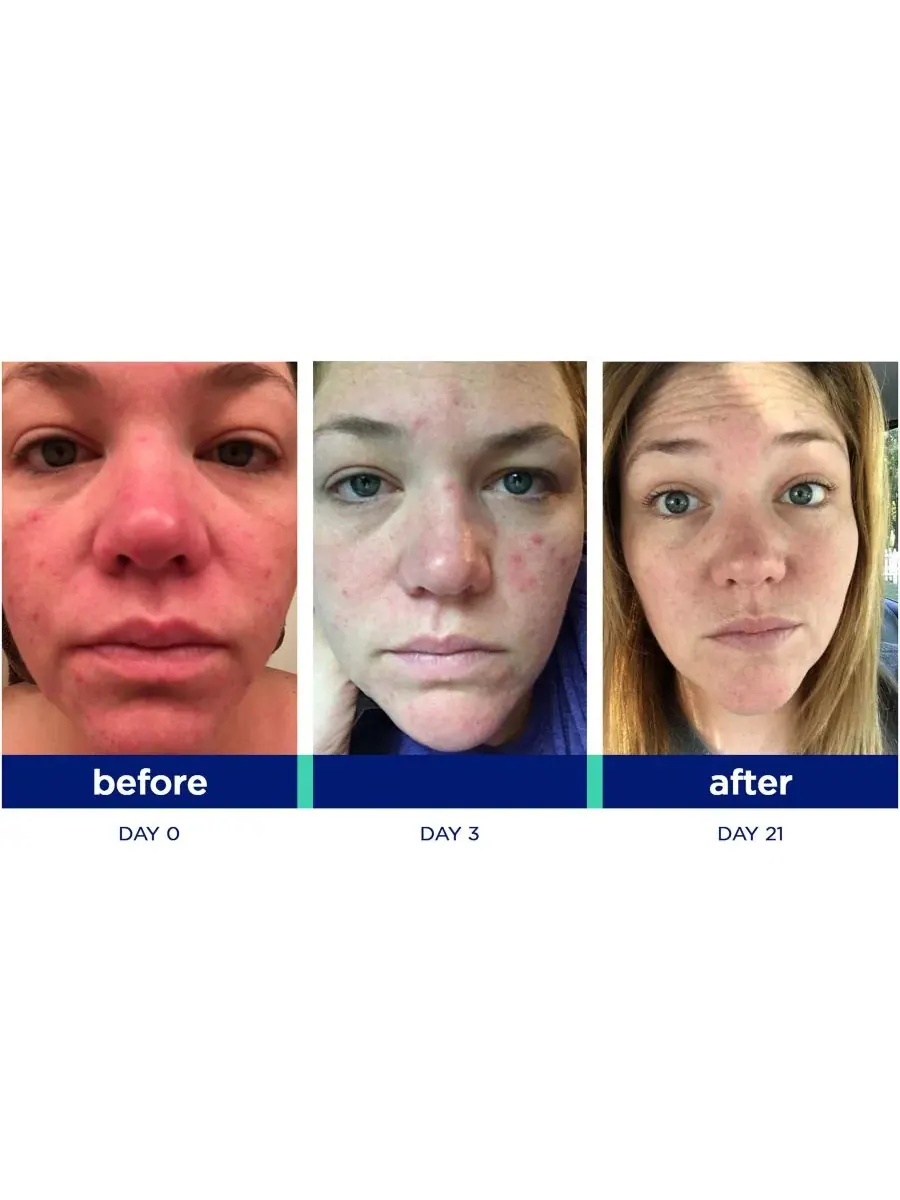 Skinkick Система Blemish Kick Duo — изображение 4 из 4