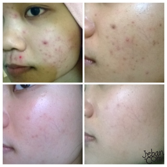 Гель от шрамов, рубцов и постакне Clenascar 7 или 15 гр