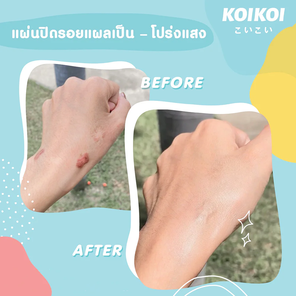 Koikoi Foundation Film — Scar Size XS [1.5 см x 1.5 см] 6pcs, Light