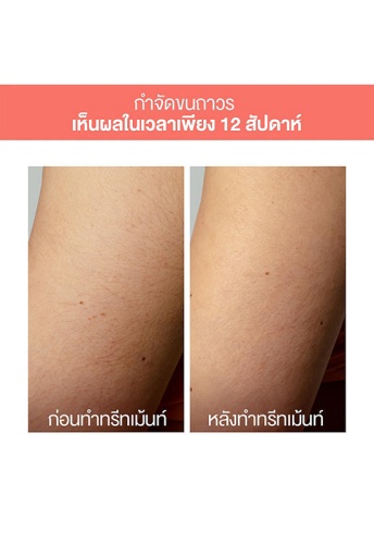 Hair Removal Device Peach 2 Go Peach - 100% оригинал фото 8