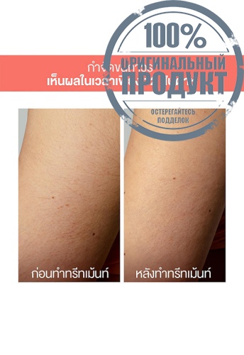 Hair Removal Device Peach 2 Go Peach - 100% оригинал фото 8 Hair Removal Device Peach 2 Go Peach - 100% оригинал фото 8