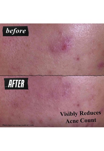 Gently Effective Blemish-Targeting Cleansing Paste 125 mL - 100% оригинал фото 4 Gently Effective Blemish-Targeting Cleansing Paste 125 mL - 100% оригинал фото 4